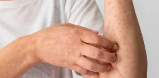 Belo Horizonte confirma mais um caso de mpox