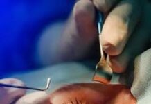 Pacientes viajam para cirurgia de catarata, mas procedimento não ocorre