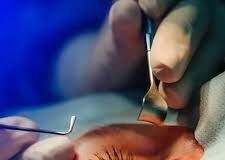 Pacientes viajam para cirurgia de catarata, mas procedimento não ocorre
